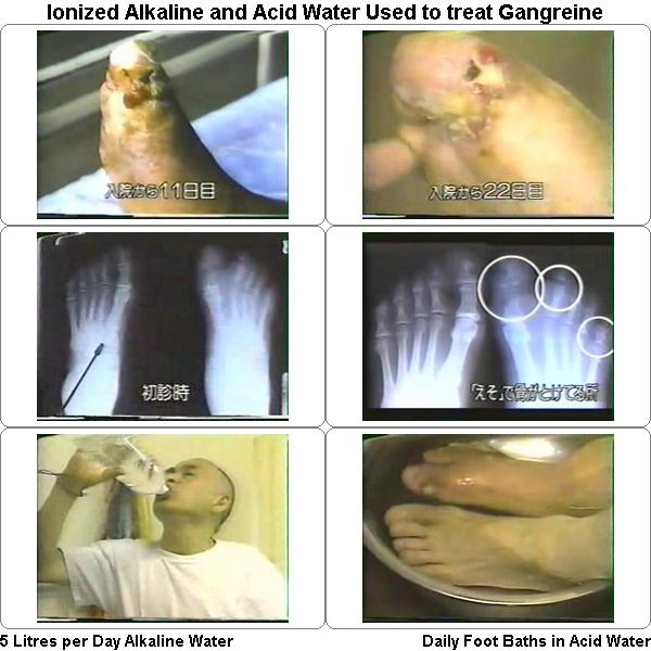 Ionized Water Used to Treat Diabetes Induced Gangrene 