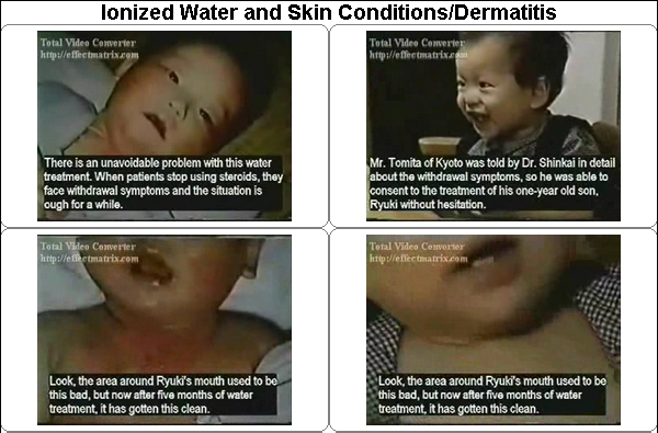 Ionized Water and Skin Conditions